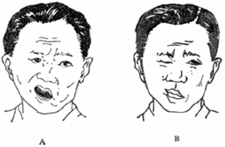 面瘫可以吃凉瓜